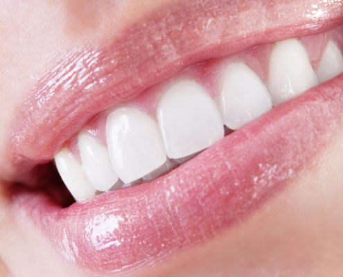 Dental veneers - Lausanne Smile Clinic - Quality veneers